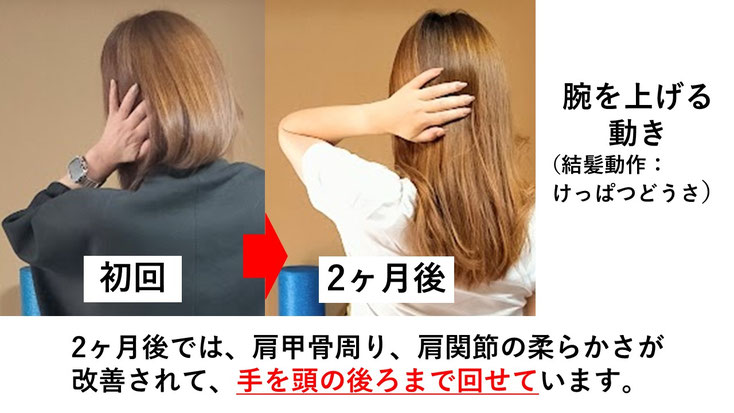 五十肩の施術例。初回から2か月後にかけて肩の可動域が改善し、腕を痛み無く後ろに回せるようになった症例