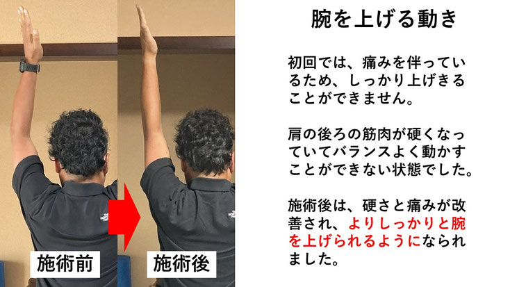 五十肩の施術例。初回の施術前後で肩の痛みと動きのスムーズさが改善した症例。
