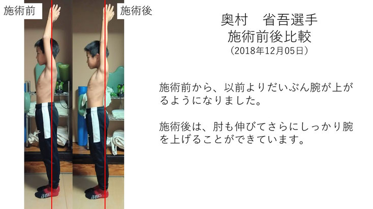 肩関節の痛み　姿勢　肩甲骨　肩甲骨痛み　背中の痛み　野球肩の原因　野球肩原因　野球肩治し方　野球肩体操　野球肩ストレッチ　野球　野球肩　肩が痛い　ピッチャー　リトルリーガーズショルダー　腱板損傷　投球傷害　水泳　競泳　腰痛　分離症　分離すべり症　水泳肩スイマーズショルダー　水泳肩　スイマーズショルダー治療　スイマーズショルダー治るのか　岐阜　岐阜市　岐阜市茜部　岐阜市東鶉　岐阜市南鶉　岐阜市中鶉　岐阜市柳津町　羽島市　羽島郡　笠松町　岐南町　茜部　鶉　東鶉　中鶉　南鶉　柳津　笠松　