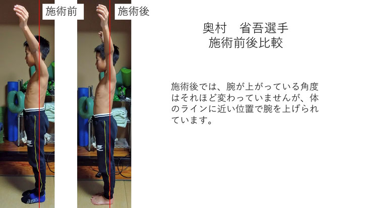 肩関節の痛み　姿勢　肩甲骨　肩甲骨痛み　背中の痛み　野球肩の原因　野球肩原因　野球肩治し方　野球肩体操　野球肩ストレッチ　野球　野球肩　肩が痛い　ピッチャー　リトルリーガーズショルダー　腱板損傷　投球傷害　水泳　競泳　腰痛　分離症　分離すべり症　水泳肩スイマーズショルダー　水泳肩　スイマーズショルダー治療　スイマーズショルダー治るのか　岐阜　岐阜市　岐阜市茜部　岐阜市東鶉　岐阜市南鶉　岐阜市中鶉　岐阜市柳津町　羽島市　羽島郡　笠松町　岐南町　茜部　鶉　東鶉　中鶉　南鶉　柳津　笠松　