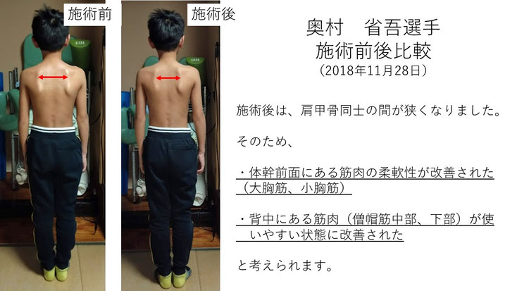 肩関節の痛み　姿勢　肩甲骨　肩甲骨痛み　背中の痛み　野球肩の原因　野球肩原因　野球肩治し方　野球肩体操　野球肩ストレッチ　野球　野球肩　肩が痛い　ピッチャー　リトルリーガーズショルダー　腱板損傷　投球傷害　水泳　競泳　腰痛　分離症　分離すべり症　水泳肩スイマーズショルダー　水泳肩　スイマーズショルダー治療　スイマーズショルダー治るのか　岐阜　岐阜市　岐阜市茜部　岐阜市東鶉　岐阜市南鶉　岐阜市中鶉　岐阜市柳津町　羽島市　羽島郡　笠松町　岐南町　茜部　鶉　東鶉　中鶉　南鶉　柳津　笠松　