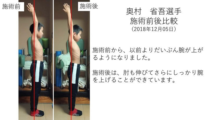 肩関節の痛み　姿勢　肩甲骨　肩甲骨痛み　背中の痛み　野球肩の原因　野球肩原因　野球肩治し方　野球肩体操　野球肩ストレッチ　野球　野球肩　肩が痛い　ピッチャー　リトルリーガーズショルダー　腱板損傷　投球傷害　水泳　競泳　腰痛　分離症　分離すべり症　水泳肩スイマーズショルダー　水泳肩　スイマーズショルダー治療　スイマーズショルダー治るのか　岐阜　岐阜市　岐阜市茜部　岐阜市東鶉　岐阜市南鶉　岐阜市中鶉　岐阜市柳津町　羽島市　羽島郡　笠松町　岐南町　茜部　鶉　東鶉　中鶉　南鶉　柳津　笠松　