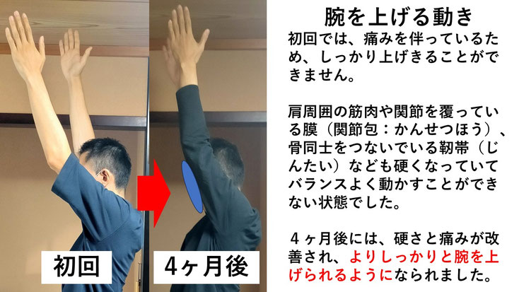 五十肩の施術例。初回から4か月後にかけて肩の可動域が改善し、腕を後ろに回せるようになった症例
