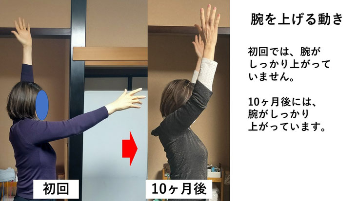五十肩の施術例。初回から10か月後にかけて肩の可動域が改善し、腕を上げることができるようになった症例。