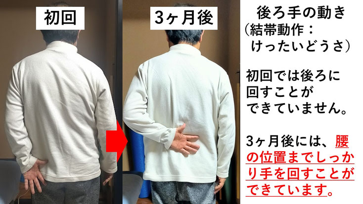 五十肩の施術例。初回から3ヶ月後には肩の可動域が改善し、腕を痛み無く後ろに回せるようになった症例
