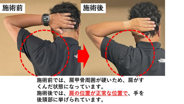 五十肩の施術例。初回の施術前後で肩の痛みと動きのスムーズさが改善した症例。