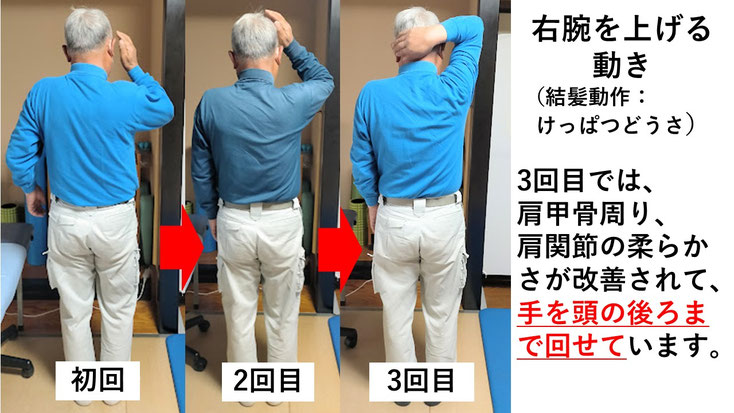 五十肩の施術例。初回から3回目に肩の可動域が改善し、腕を痛み無く頭の後ろに上げられるようになった症例