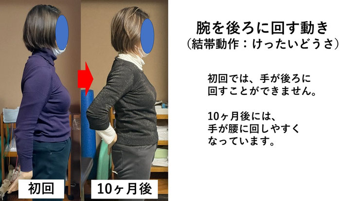 五十肩の施術例。初回から10か月後にかけて肩の可動域が改善し、腕を後ろに回せるようになった症例。