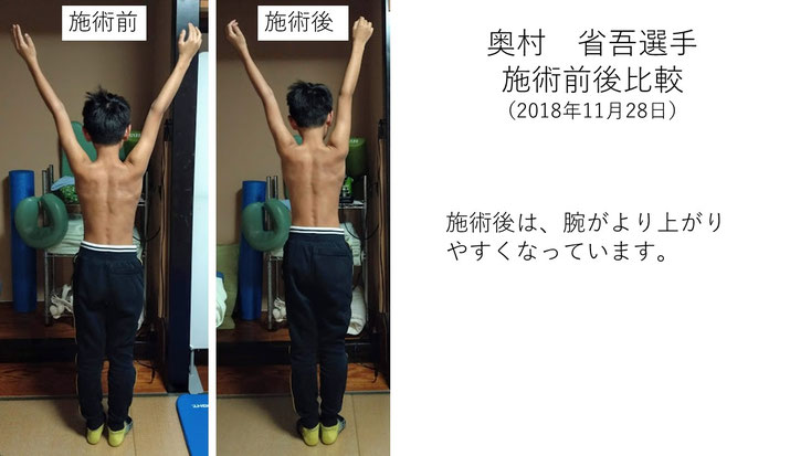 肩関節の痛み　姿勢　肩甲骨　肩甲骨痛み　背中の痛み　野球肩の原因　野球肩原因　野球肩治し方　野球肩体操　野球肩ストレッチ　野球　野球肩　肩が痛い　ピッチャー　リトルリーガーズショルダー　腱板損傷　投球傷害　水泳　競泳　腰痛　分離症　分離すべり症　水泳肩スイマーズショルダー　水泳肩　スイマーズショルダー治療　スイマーズショルダー治るのか　岐阜　岐阜市　岐阜市茜部　岐阜市東鶉　岐阜市南鶉　岐阜市中鶉　岐阜市柳津町　羽島市　羽島郡　笠松町　岐南町　茜部　鶉　東鶉　中鶉　南鶉　柳津　笠松　