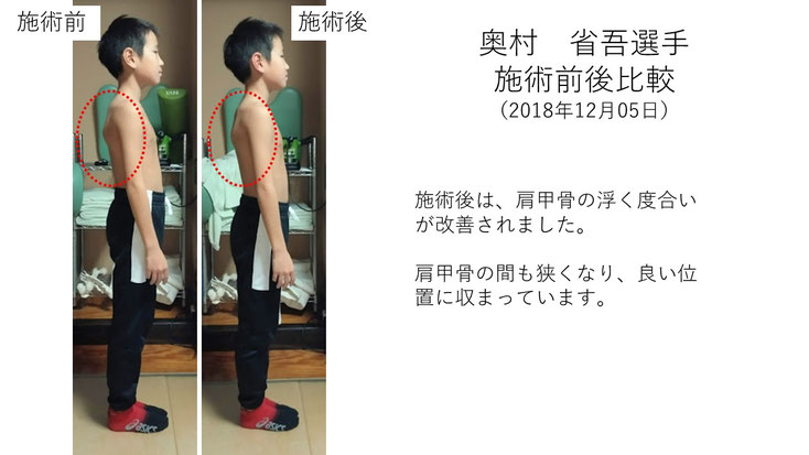 肩関節の痛み　姿勢　肩甲骨　肩甲骨痛み　背中の痛み　野球肩の原因　野球肩原因　野球肩治し方　野球肩体操　野球肩ストレッチ　野球　野球肩　肩が痛い　ピッチャー　リトルリーガーズショルダー　腱板損傷　投球傷害　水泳　競泳　腰痛　分離症　分離すべり症　水泳肩スイマーズショルダー　水泳肩　スイマーズショルダー治療　スイマーズショルダー治るのか　岐阜　岐阜市　岐阜市茜部　岐阜市東鶉　岐阜市南鶉　岐阜市中鶉　岐阜市柳津町　羽島市　羽島郡　笠松町　岐南町　茜部　鶉　東鶉　中鶉　南鶉　柳津　笠松　