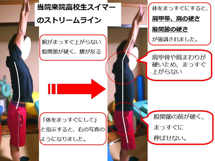 水泳　競泳　肩痛　肩が痛い　インピンジメント症候群　腰が痛い　腰痛　分離症　分離すべり症　水泳肩スイマーズショルダー　水泳肩　スイマーズショルダー治療　スイマーズショルダー治るのか　岐阜　岐阜市　岐阜市茜部　岐阜市鶉　岐阜市柳津　羽島市　羽島郡　笠松町　岐南町　茜部　鶉　柳津　笠松　