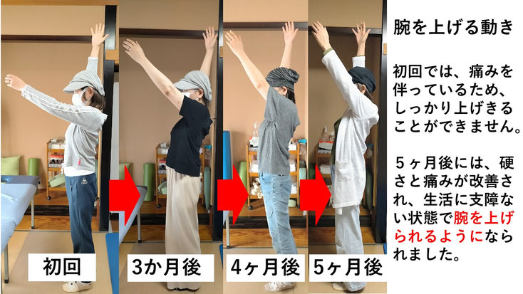 五十肩の施術例。初回から5ヶ月後には肩の可動域が改善し、腕を痛み無く上げられるようになった症例