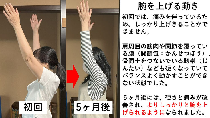 五十肩の施術例。初回から5か月後にかけて肩の可動域が改善し、腕を真上に上げられるようになった症例