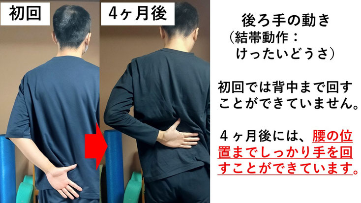五十肩の施術例。初回から4か月後にかけて肩の可動域が改善し、腕を後ろに回せるようになった症例