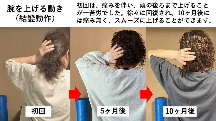 五十肩の施術例。初回から10か月後にかけて肩の可動域が改善し、手を頭の後ろまで上げられるようになり、夜間痛も無くなった症例