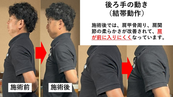 五十肩の施術例。初回の施術前後で肩の痛みと動きのスムーズさが改善した症例。