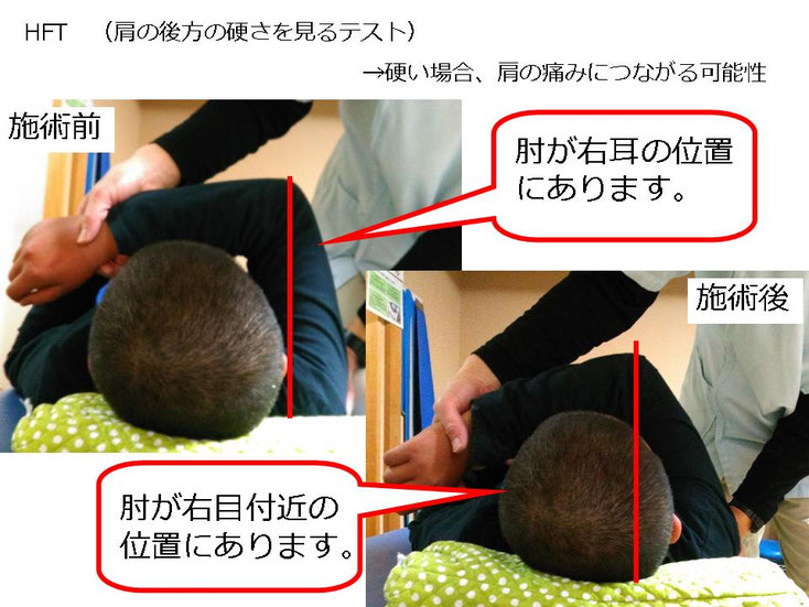 野球 野球肩 肩が痛い ピッチャー リトルリーガーズショルダー 腱板損傷 投球傷害 水泳 競泳 腰痛 分離症 分離すべり症 水泳肩スイマーズショルダー 水泳肩 スイマーズショルダー治療 スイマーズショルダー治るのか 岐阜 岐阜市 岐阜市茜部 岐阜市東鶉 岐阜市南鶉 岐阜市中鶉 岐阜市柳津町 羽島市 羽島郡 笠松町 岐南町 茜部 鶉 東鶉 中鶉 南鶉 柳津 笠松