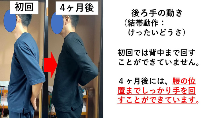 五十肩の施術例。初回から4か月後にかけて肩の可動域が改善し、腕を後ろに回せるようになった症例