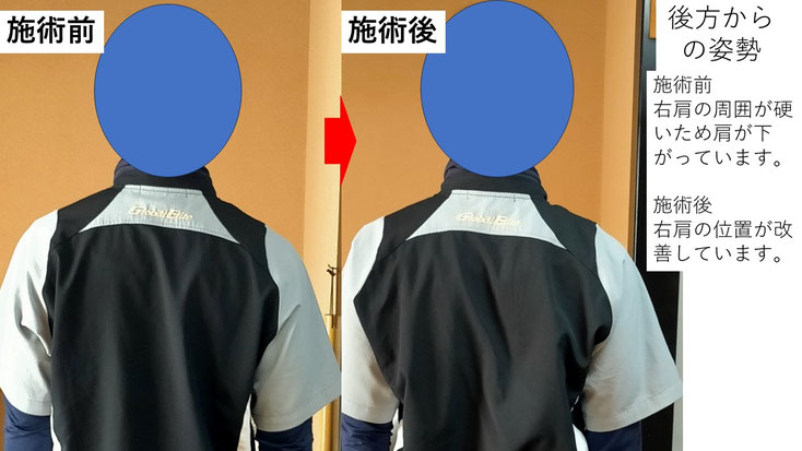 右投げ社会人外野手の野球肩後方からの姿勢施術前後比較　