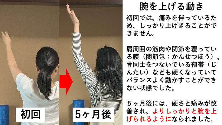五十肩の施術例。初回から5か月後にかけて肩の可動域が改善し、腕を真上に上げられるようになった症例