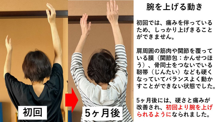五十肩の施術例。初回から5か月後にかけて肩の可動域が改善し、腕を痛み無く上に上げられるようになった症例