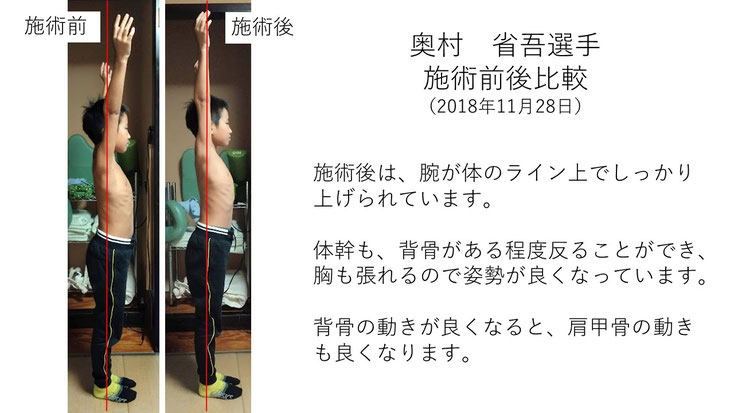 肩関節の痛み　姿勢　肩甲骨　肩甲骨痛み　背中の痛み　野球肩の原因　野球肩原因　野球肩治し方　野球肩体操　野球肩ストレッチ　野球　野球肩　肩が痛い　ピッチャー　リトルリーガーズショルダー　腱板損傷　投球傷害　水泳　競泳　腰痛　分離症　分離すべり症　水泳肩スイマーズショルダー　水泳肩　スイマーズショルダー治療　スイマーズショルダー治るのか　岐阜　岐阜市　岐阜市茜部　岐阜市東鶉　岐阜市南鶉　岐阜市中鶉　岐阜市柳津町　羽島市　羽島郡　笠松町　岐南町　茜部　鶉　東鶉　中鶉　南鶉　柳津　笠松　