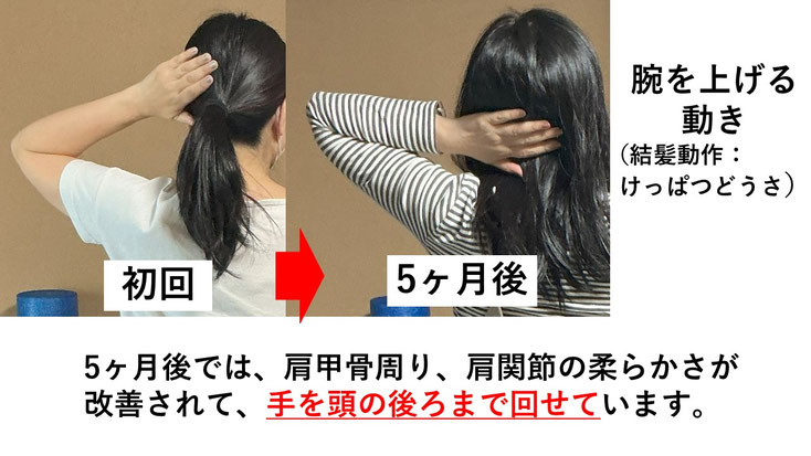 五十肩の施術例。初回から5か月後にかけて肩の可動域が改善し、腕を頭の後ろに上げられるようになった症例