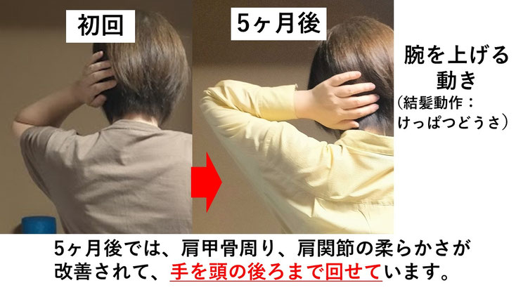 五十肩の施術例。初回から5か月後にかけて肩の可動域が改善し、手を頭の後ろまで回せるようになった症例