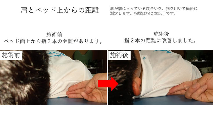 肩関節の痛み　姿勢　姿勢改善　肩甲骨　肩甲骨はがし　肩甲骨痛み　背中の痛み　野球肩の原因　野球肩原因　野球肩治し方　野球肩体操　野球肩ストレッチ　野球　野球肩　肩が痛い　ピッチャー　リトルリーガーズショルダー　腱板損傷　投球傷害　水泳　競泳　腰痛　分離症　分離すべり症　水泳肩スイマーズショルダー　水泳肩　スイマーズショルダー治療　スイマーズショルダー治るのか　岐阜　岐阜市　岐阜市茜部　岐阜市東鶉　岐阜市南鶉　岐阜市中鶉　岐阜市柳津町　羽島市　羽島郡　笠松町　岐南町　茜部　鶉　東鶉　中鶉　南鶉　柳津　笠松　