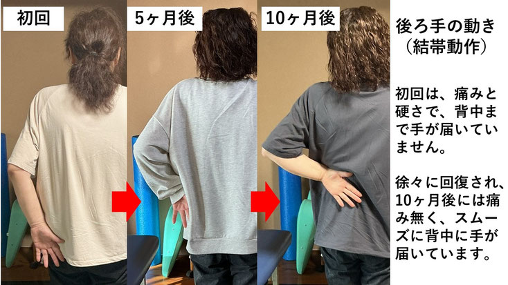 五十肩の施術例。初回から10か月後にかけて肩の可動域が改善し、手を後ろ回せるようになり、夜間痛も無くなった症例