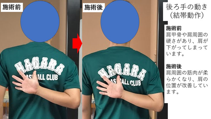 右投げ高校生内野手の野球肩施術前後の後ろ手の動きの比較