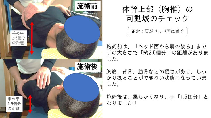 右投げ高校生内野手の野球肩施術前後の体幹をひねる動きの比較