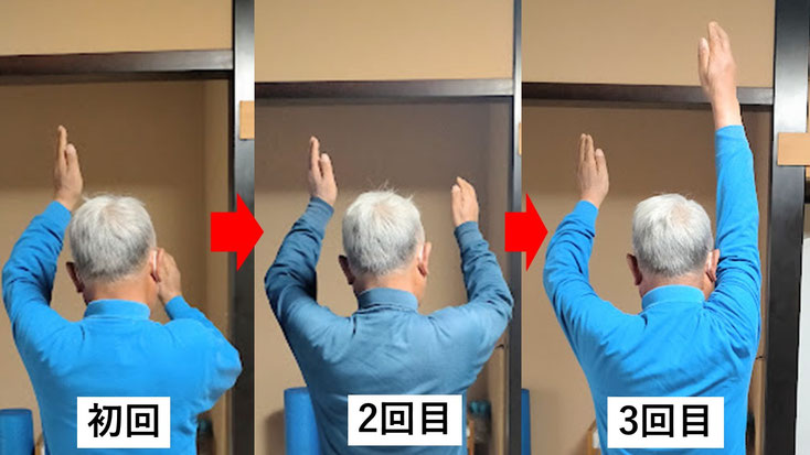 五十肩の施術例。初回から3回目に肩の可動域が改善し、腕を痛み無く上げられるようになった症例