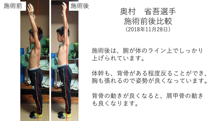 肩関節の痛み　姿勢　肩甲骨　肩甲骨痛み　背中の痛み　野球肩の原因　野球肩原因　野球肩治し方　野球肩体操　野球肩ストレッチ　野球　野球肩　肩が痛い　ピッチャー　リトルリーガーズショルダー　腱板損傷　投球傷害　水泳　競泳　腰痛　分離症　分離すべり症　水泳肩スイマーズショルダー　水泳肩　スイマーズショルダー治療　スイマーズショルダー治るのか　岐阜　岐阜市　岐阜市茜部　岐阜市東鶉　岐阜市南鶉　岐阜市中鶉　岐阜市柳津町　羽島市　羽島郡　笠松町　岐南町　茜部　鶉　東鶉　中鶉　南鶉　柳津　笠松　