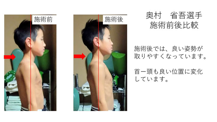 肩関節の痛み　姿勢　肩甲骨　肩甲骨痛み　背中の痛み　野球肩の原因　野球肩原因　野球肩治し方　野球肩体操　野球肩ストレッチ　野球　野球肩　肩が痛い　ピッチャー　リトルリーガーズショルダー　腱板損傷　投球傷害　水泳　競泳　腰痛　分離症　分離すべり症　水泳肩スイマーズショルダー　水泳肩　スイマーズショルダー治療　スイマーズショルダー治るのか　岐阜　岐阜市　岐阜市茜部　岐阜市東鶉　岐阜市南鶉　岐阜市中鶉　岐阜市柳津町　羽島市　羽島郡　笠松町　岐南町　茜部　鶉　東鶉　中鶉　南鶉　柳津　笠松　