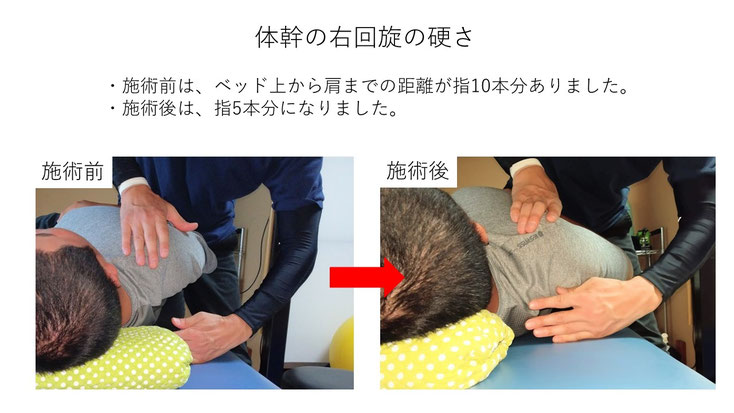 肩関節の痛み　姿勢　姿勢改善　肩甲骨　肩甲骨はがし　肩甲骨痛み　背中の痛み　野球肩の原因　野球肩原因　野球肩治し方　野球肩体操　野球肩ストレッチ　野球　野球肩　肩が痛い　ピッチャー　リトルリーガーズショルダー　腱板損傷　投球傷害　水泳　競泳　腰痛　分離症　分離すべり症　水泳肩スイマーズショルダー　水泳肩　スイマーズショルダー治療　スイマーズショルダー治るのか　岐阜　岐阜市　岐阜市茜部　岐阜市東鶉　岐阜市南鶉　岐阜市中鶉　岐阜市柳津町　羽島市　羽島郡　笠松町　岐南町　茜部　鶉　東鶉　中鶉　南鶉　柳津　笠松　
