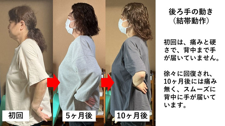 五十肩の施術例。初回から10か月後にかけて肩の可動域が改善し、手を後ろ回せるようになり、夜間痛も無くなった症例