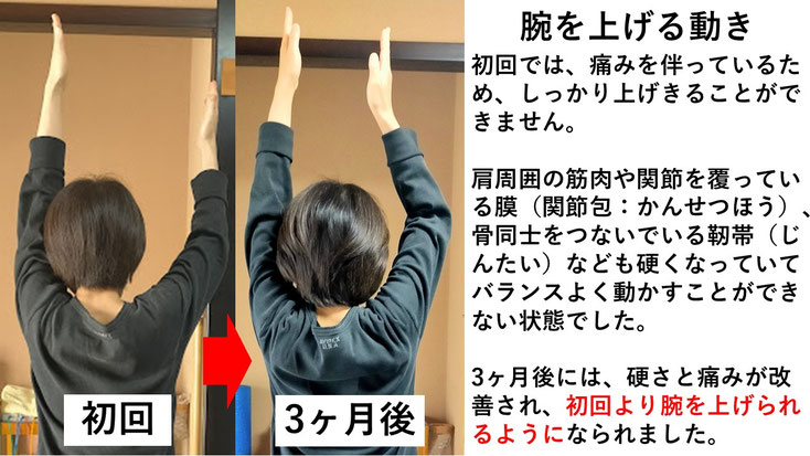 五十肩の施術例。初回から3か月後にかけて肩の可動域が改善し、腕を痛み無く上げられるようになった症例