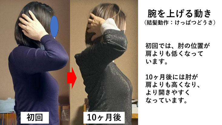 五十肩の施術例。初回から10か月後にかけて肩の可動域が改善し、腕を頭の後ろに挙げられるようになった症例。