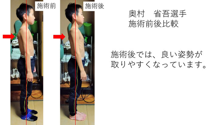 肩関節の痛み　姿勢　肩甲骨　肩甲骨痛み　背中の痛み　野球肩の原因　野球肩原因　野球肩治し方　野球肩体操　野球肩ストレッチ　野球　野球肩　肩が痛い　ピッチャー　リトルリーガーズショルダー　腱板損傷　投球傷害　水泳　競泳　腰痛　分離症　分離すべり症　水泳肩スイマーズショルダー　水泳肩　スイマーズショルダー治療　スイマーズショルダー治るのか　岐阜　岐阜市　岐阜市茜部　岐阜市東鶉　岐阜市南鶉　岐阜市中鶉　岐阜市柳津町　羽島市　羽島郡　笠松町　岐南町　茜部　鶉　東鶉　中鶉　南鶉　柳津　笠松　