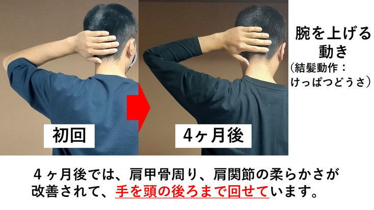 五十肩の施術例。初回から4か月後にかけて肩の可動域が改善し、腕を頭の後ろに回せるようになった症例