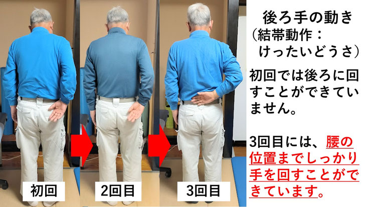 五十肩の施術例。初回から3回目に肩の可動域が改善し、腕を痛み無く後ろに上げられるようになった症例