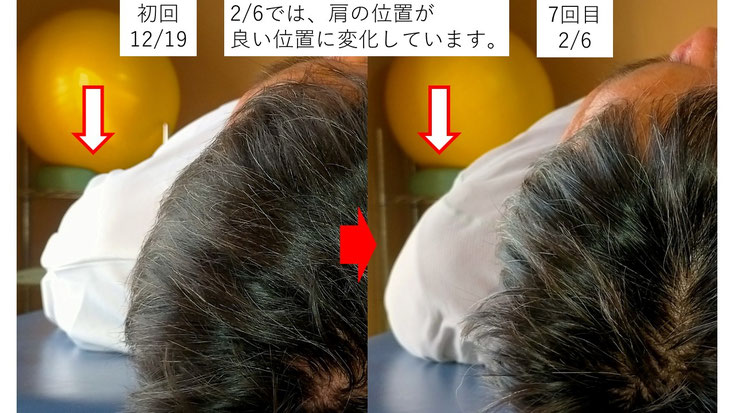 五十肩の施術例。初回から3か月後にかけて肩の可動域が改善し、肩の位置が改善した症例。