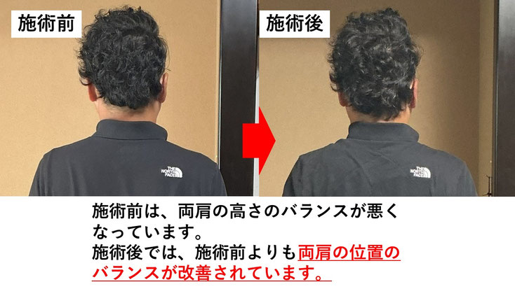 五十肩の施術例。初回の施術前後で肩の状態が改善した症例。