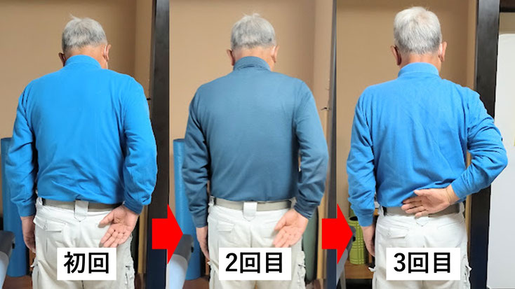 五十肩の施術例。初回から3回目に肩の可動域が改善し、腕を痛み無く後ろに上げられるようになった症例