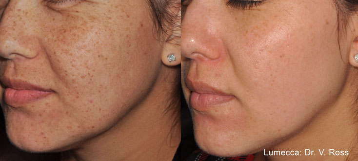 Endgültig Pigmentflecken loswerden Carol's Beauty Bar Binningen/Basel