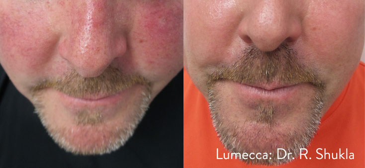Couperose oder Rosacea behandeln mit IPL