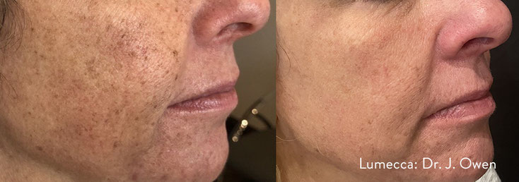 IPL Behandlung gegen Pigmentflecken, Altersflecken, Aknemale, Melasma