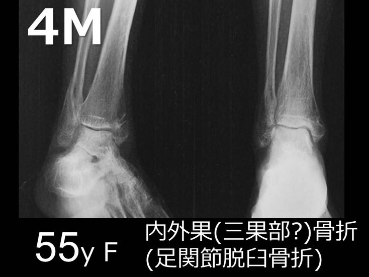 右足関節脱臼骨折 接骨院 豊田市 骨折 脱臼 スポーツ外傷 交通事故