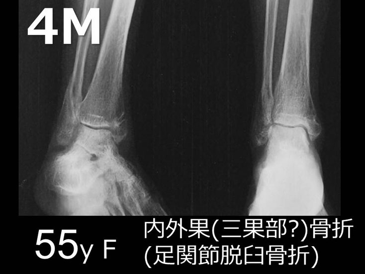 豊田市　おおつか接骨院　右足関節脱臼骨折　レントゲン　４か月